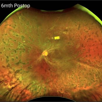 Proliferative Diabetic Retinopathy Tractional Retinal Detachment (PDR ...