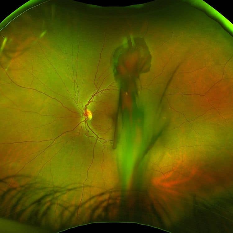 Retinal Aterial Macroaneurysm