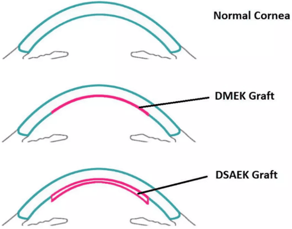 Endothelial Keratoplasty lenses 1