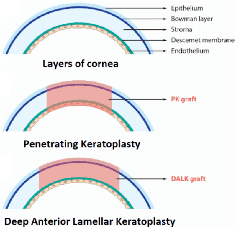 Penetrating Keratoplasty and Deep Anterior Lamellar Keratoplasty layers