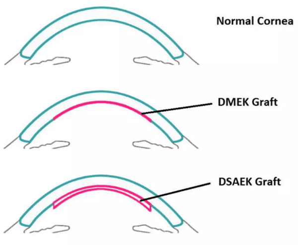 corneal transplant grafts cornea