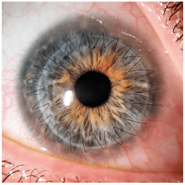 corneal transplants eye