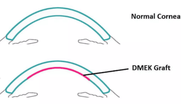 uchs-corneal-endothelial-dystrophy-cornea